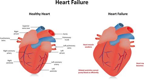 global lv hypokinesia|global hypokinesis treatment and medications.